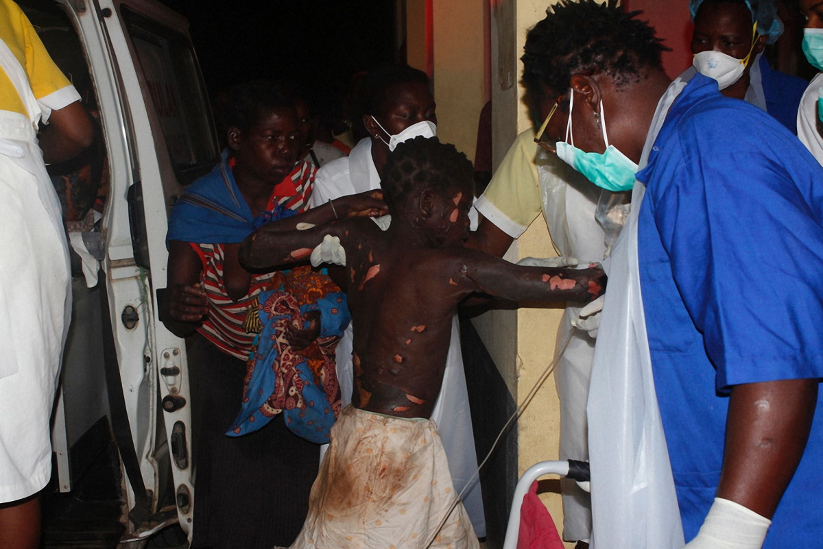 A badly burned child arrives at the Provincial Hospital in Tete on November 17, 2016, after a truck carrying petrol burst into flames. At least 43 people were killed and 110 others injured on November 17 when a truck carrying petrol blew up in western Moz