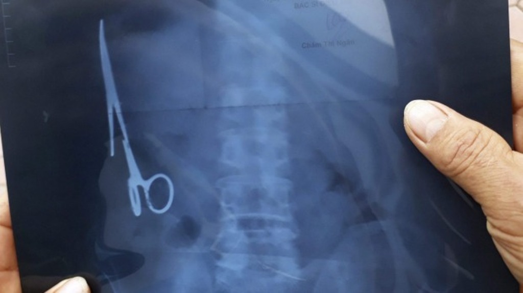 An X-ray of Ma Van Nhat's stomach show where the scissors have been hiding for years.