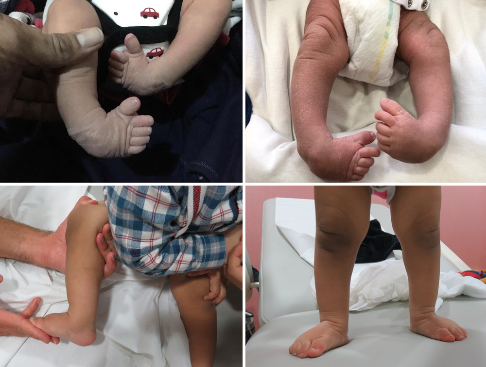 The two pictures at the top shows Hasan’s clubfoot at birth and the ones at the bottom shows the result after Ponseti treatment