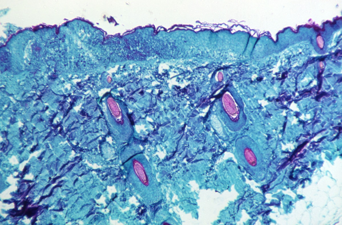 A section of skin tissue, harvested from a lesion on the skin of a monkey, that had been infected with Monkeypox virus, is seen at 50X magnification on day four of rash development in 1968. CDC/Handout via REUTERS. 