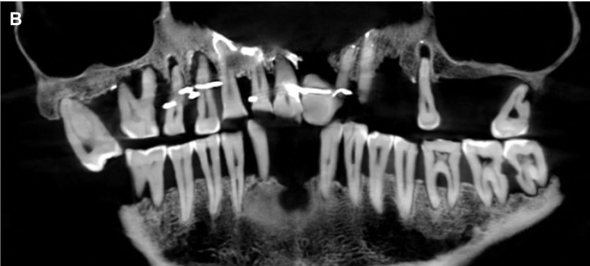 A handout picture released by the French National Institute of Archaeological Researchs (Inrap) on January 25, 2023 shows a close up in picture and in radiograph of the skull of Anne d'Alegre, a 17th-century aristocrat. (Photo by Handout / INRAP / AFP) 