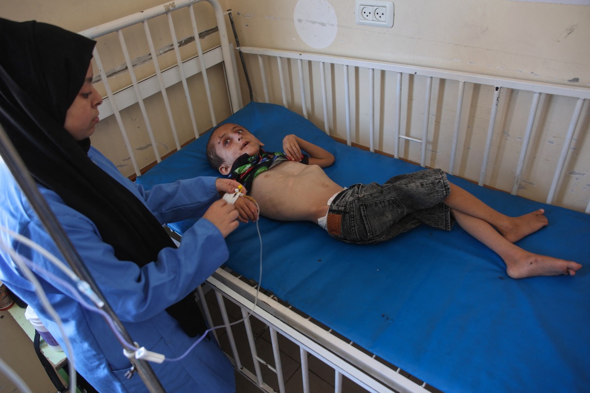 Palestinian boy Muhammad Shaaban suffering from malnutrition receives care at the Kamal Adwan hospital in Beit Lahia in the northern Gaza Strip on July 2, 2024. (Photo by Omar Al-Qattaa / AFP)
