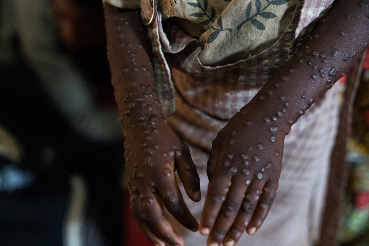 Photo for demonstration purposes. A patient with a severe form of the mpox epidemic is treated at the Kavumu hospital, 30 km north of Bukavu in eastern Democratic Republic of Congo, August 24, 2024. Photo by Glody MURHABAZI / AFP.