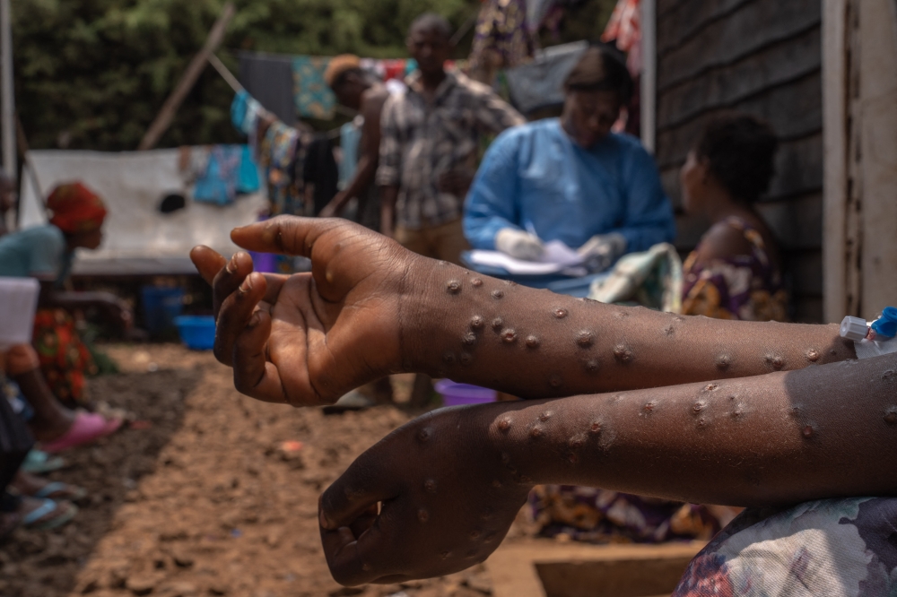 A patient suffering from mpox sits on a bench at the Kavumu hospital, 30 km north of Bukavu in eastern Democratic Republic of Congo, August 24, 2024. Photo by Glody MURHABAZI / AFP