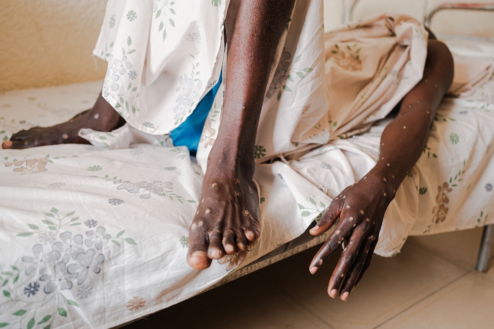 A man infected with Mpox lies on a bed inside a ward at the Kamenge University Hospital's Mpox treatment center in Bujumbura on August 22, 2024. Photo by Tchandrou NITANGA / AFP