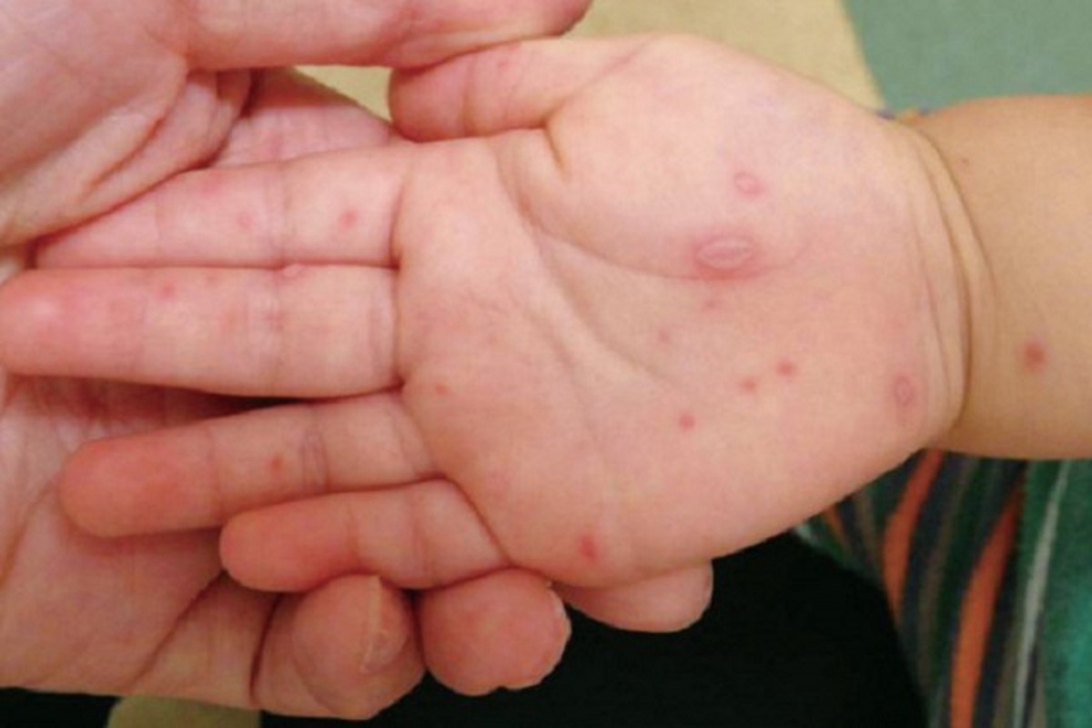 File photo for representational purposes showing a child's hand after being diagnosed with hand, mouth, and foot disease.